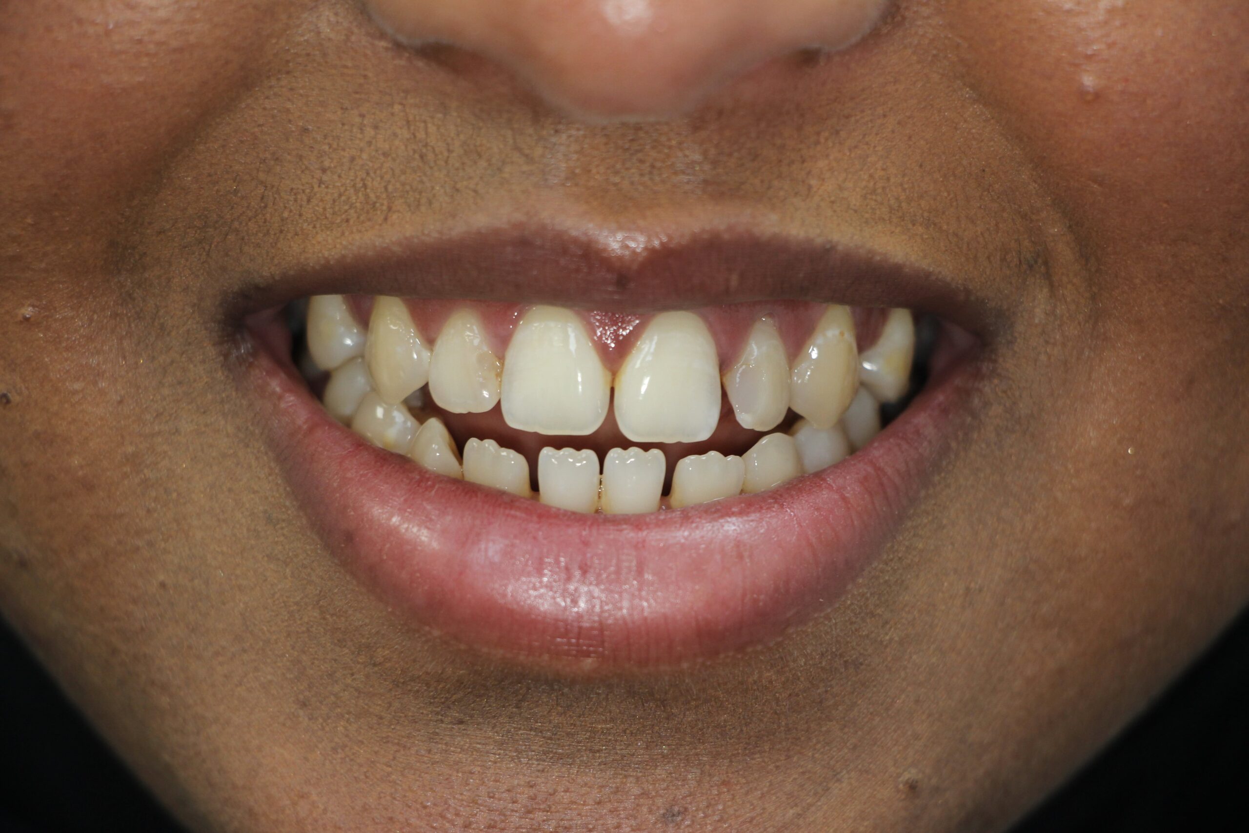 SA before-min SA before-min